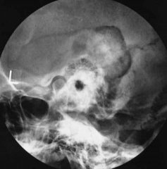 2D-Röntgen des Ohrknochens nach Stenvers